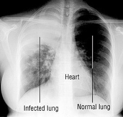 Preventing Hospital Readmission: The Role of Home Care After Pneumonia